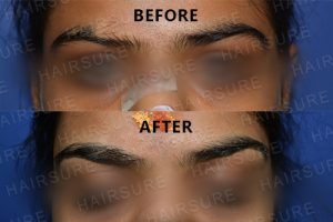 Eyebrows Restoration-image4