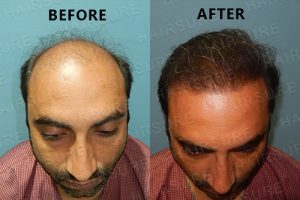Hair Reconstruction results before and after at Best Hair Transplant, One of the best perfect hair transplant surgery centre in Hyderabad