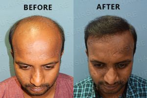 Results before and after hair transplant surgery at Best Hair Transplant, One of the best male hair fall treatment clinic in Hyderabad