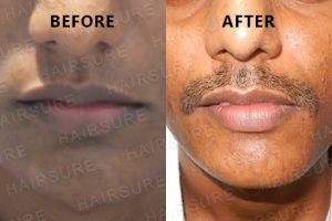 Mustache-before-afterimage12