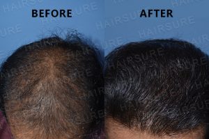 Hair Restoration Before and After Results at Best Hair Transplant, One of the best male hair loss treatment Clinic in Hyderabad