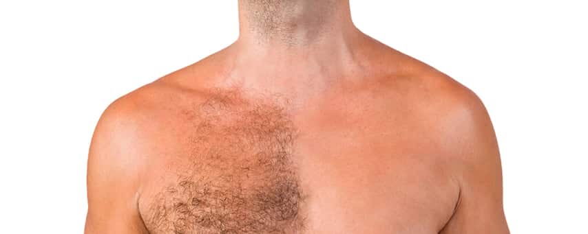 Consult with Dr Ravi Chander Rao for body hair transplant, One of the best Beard hair transplant surgery specialist in Hyderabad