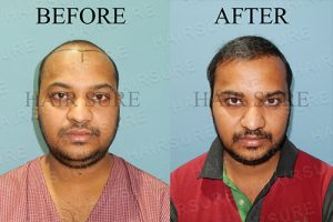Hair Transplant Surgery Before and After Results at Best Hair Transplant, One of the best male hair fall treatment hospital in Hyderabad