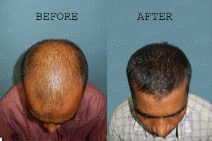 Results before and after hair transplant surgery at Best Hair Transplant, One of the best male hair loss treatment Hospital in Hyderabad