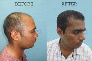 Hair Transplant Surgery Before and After Results at Best Hair Transplant, One of the best male hairline designing treatment Centre in Hyderabad