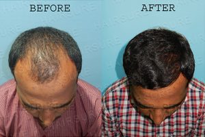 Hair transplant results before and after at Best Hair Transplant, One of the best male hairline designing treatment clinic in Hyderabad