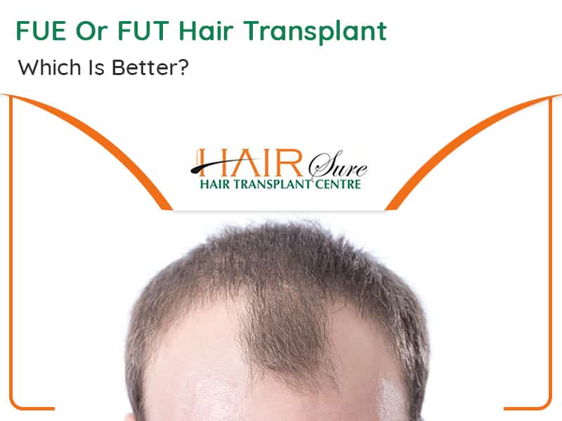 FUT Or FUE Hair Transplant – Which Is Better?
