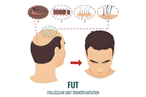 Consult Dr Sridhar Reddy for FUT and FUE hair Transplant surgery, One of the best Hair Restoration treatment Doctors in Hyderabad