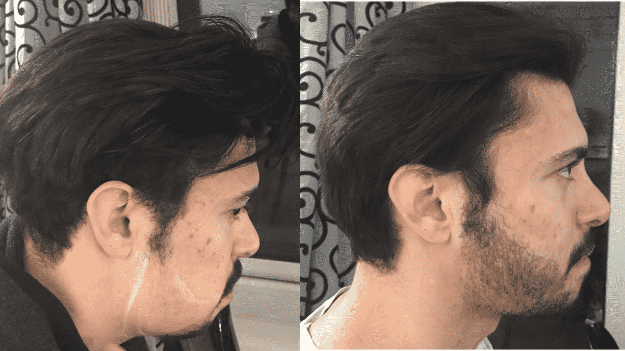 Best Things to Know If You're Considering a Beard Transplant by Dr Ravi Chander Rao, One of the best Hair loss treatment Trichologist in Hyderabad