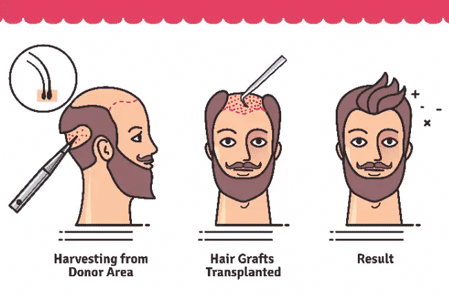 Advantages guide of Beard hair Transplant at Best Hair Transplant, One of the best Hair Reconstruction Surgery Hospitals in Hyderabad