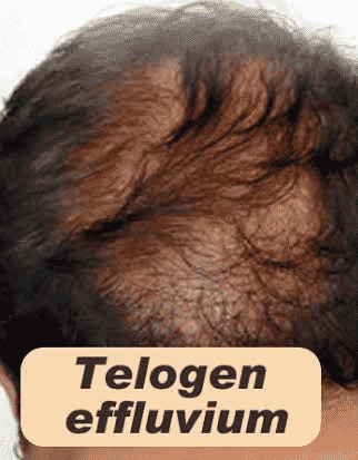 Telogen Effluvium hair loss treatment at Best Hair Transplant, One of the best Hair Transplant surgery Speciality clinic in Hyderabad