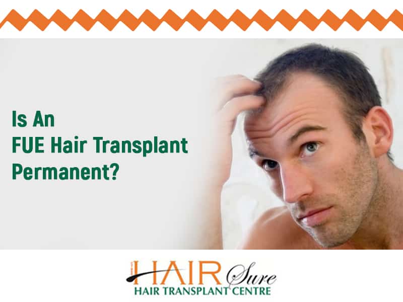 Is FUE Hair Transplant Permanent?