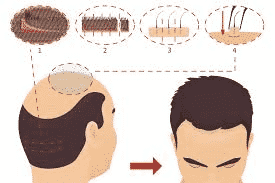 Best hair transplantation methods in Hyderabad, hair Specialists Doctors near by me