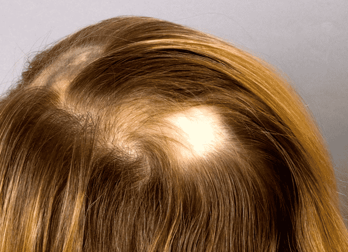 Causes Of Hair Loss In Teenage Females - Cyber Hairsure