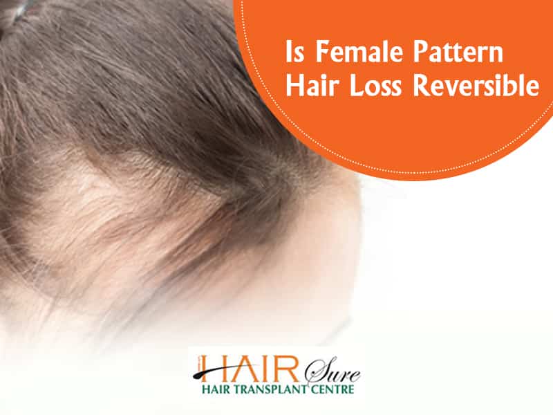 Is Female Pattern Hair Loss Reversible? - Cyber Hairsure