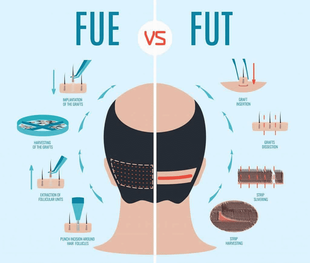 All types of Hair Transplant surgery methods at Best Hair Transplant, One of the best Hair Reconstruction Clinics in Hyderabad