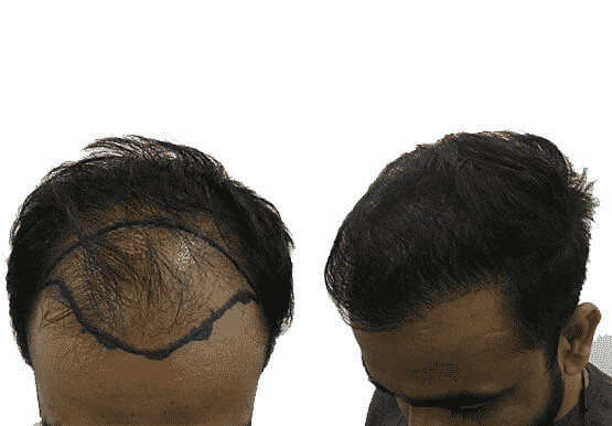 Best Clinics for Permanent Hair transplant solution in Hyderabad, best hair restoration Doctors near me