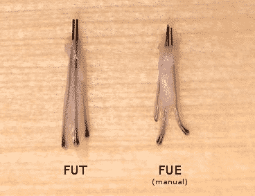 What Is FUE And How It Varies From The Strip Method?
