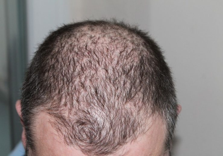 Make an Appointment for Hair loss treatment at Best Hair Transplant, One of the best Hair transplant Centres in Hyderabad