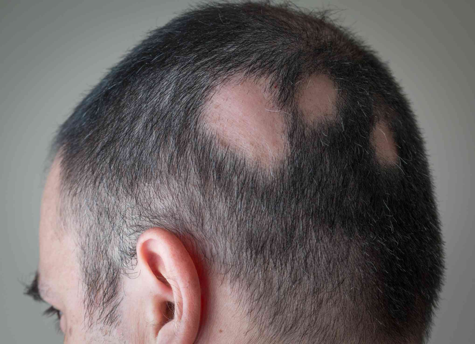 Consult to choose the best choice for Alopecia treatment at Best Hair Transplant, FUE hair restoration near Madhapur
