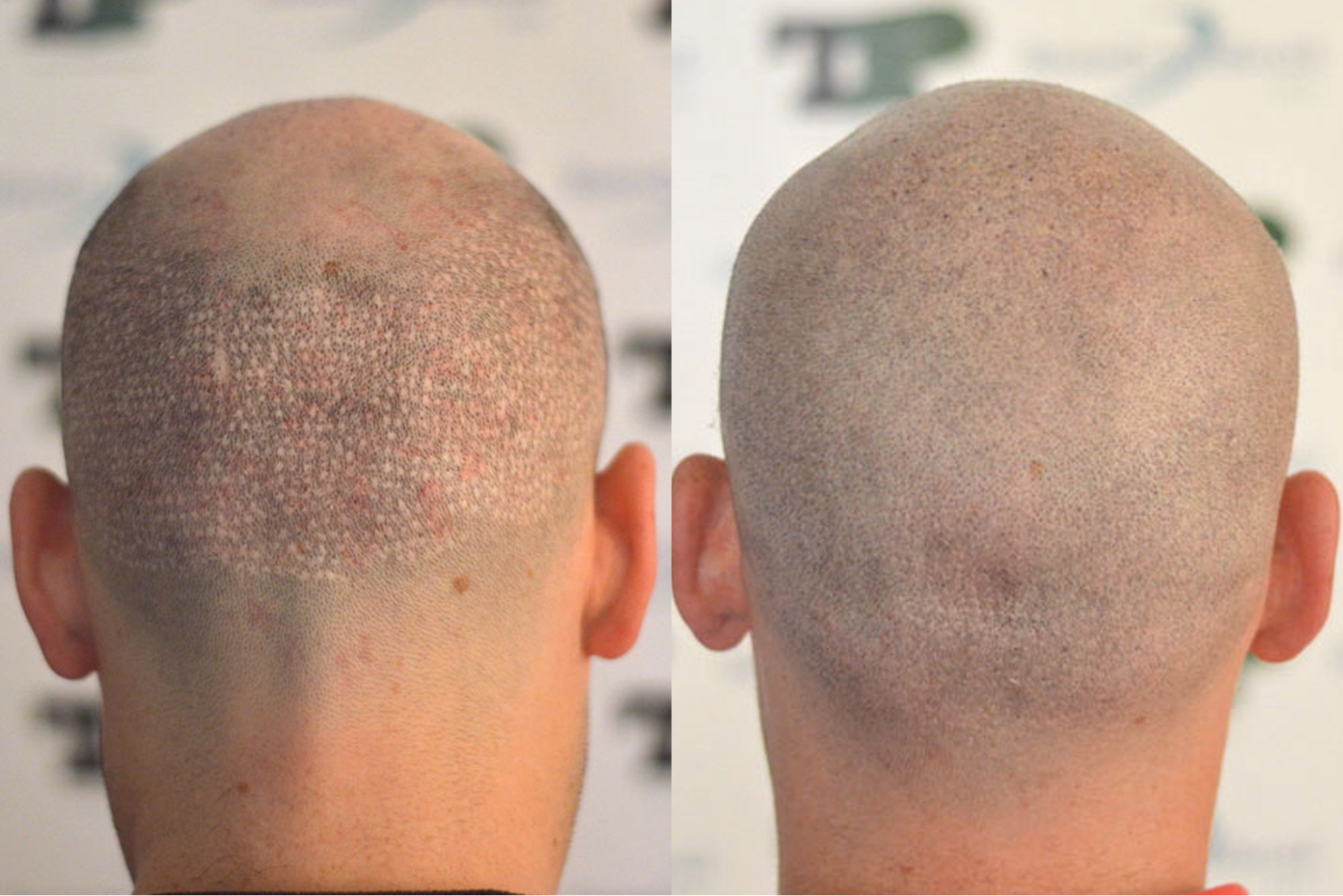 What are the hair transplant options for men with a bald head? - Cyber  Hairsure