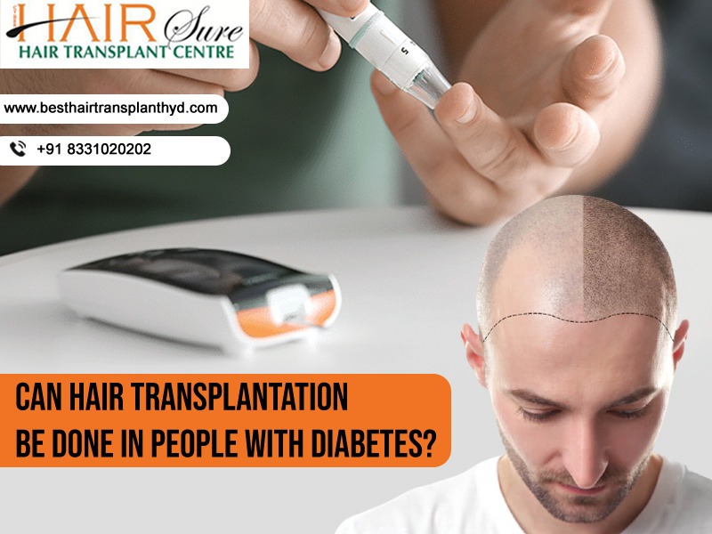 Can hair transplantation be done in people with diabetes?