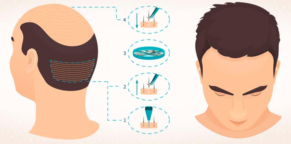 Consult for Hair transplantation at Hair Sure, hair transplant clinic in Hyderabad