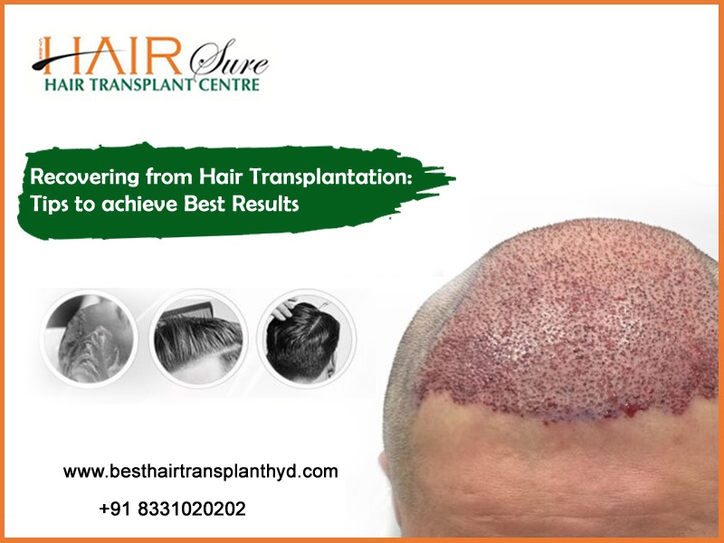 Recovering From Hair Transplantation Tips To Achieve Best Results